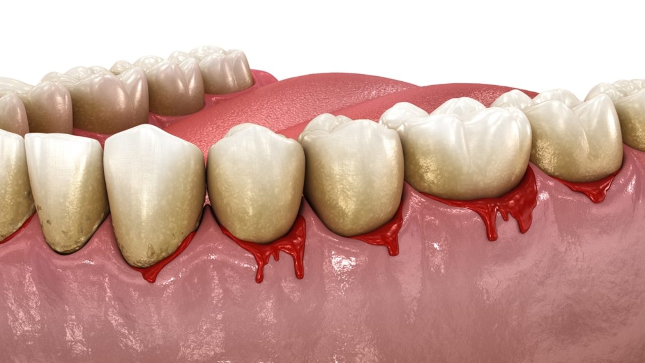 Ilustración de encías inflamadas que sangran en el borde de los dientes, con acumulación de sarro